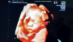 LumeaParintilor.ro ecografie saptamana 12 afla sexul bebelusului.jpg